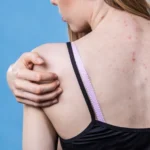 Ragazza con dermatite da sudore sulla schiena