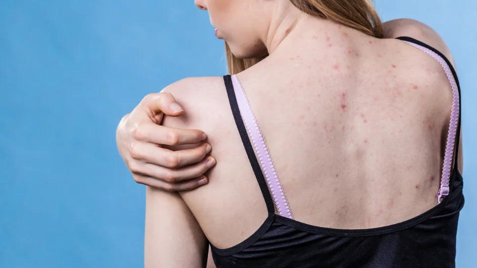 Dermatite da sudore: cos’è e quali sono i rimedi